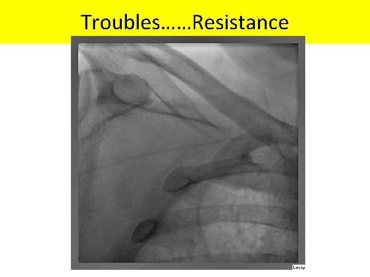 Troubles……Resistance 