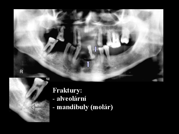 Fraktury: - alveolární - mandibuly (molár) 