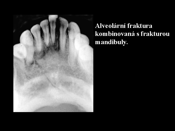 Alveolární fraktura kombinovaná s frakturou mandibuly. 