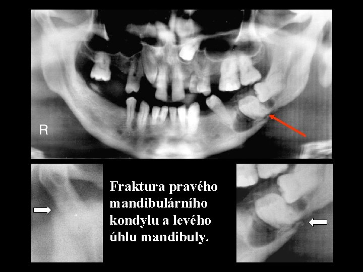 Fraktura pravého mandibulárního kondylu a levého úhlu mandibuly. 