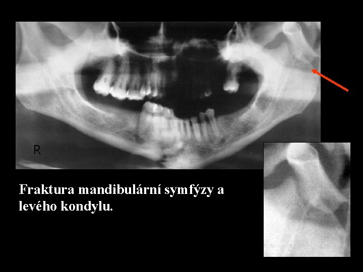 R Fraktura mandibulární symfýzy a levého kondylu. 