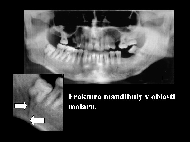 L Fraktura mandibuly v oblasti moláru. 