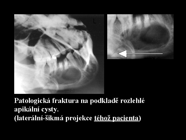 L Patologická fraktura na podkladě rozlehlé apikální cysty. (laterální-šikmá projekce téhož pacienta) 