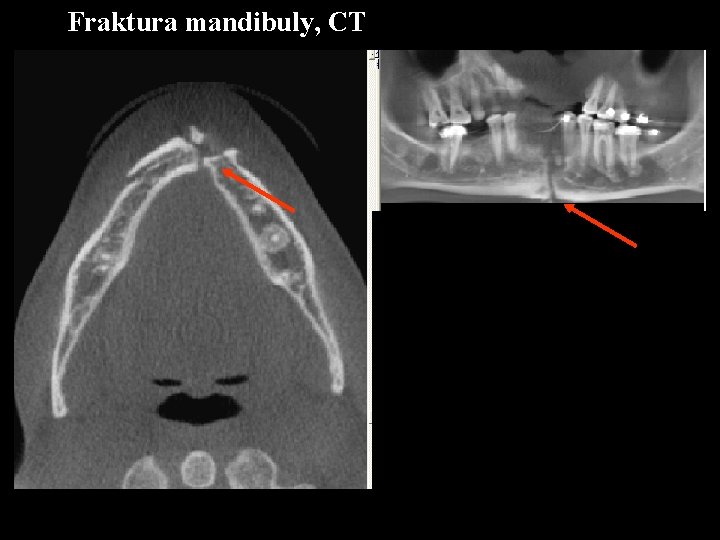Fraktura mandibuly, CT 
