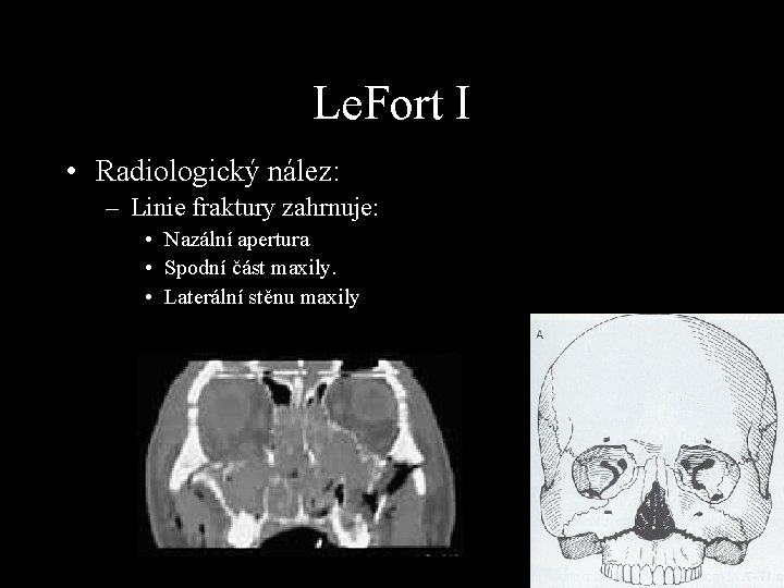 Le. Fort I • Radiologický nález: – Linie fraktury zahrnuje: • Nazální apertura •