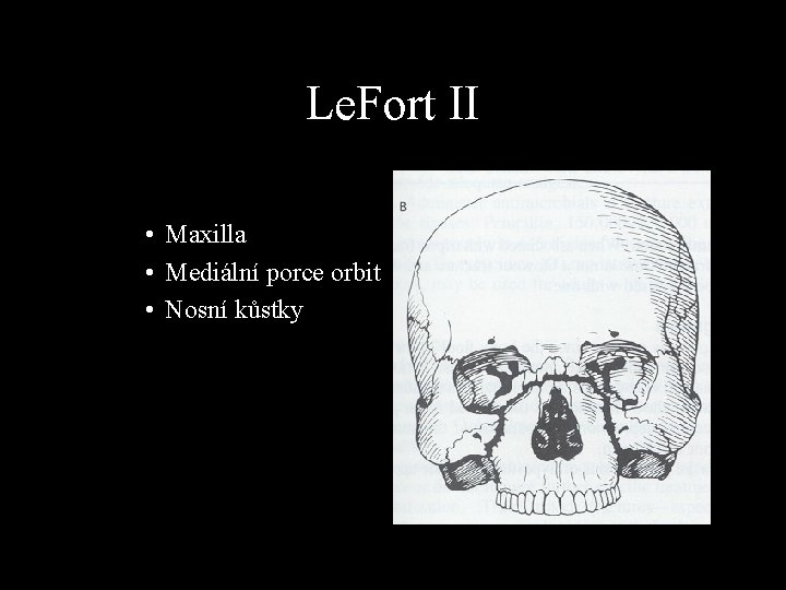 Le. Fort II • Maxilla • Mediální porce orbit • Nosní kůstky 