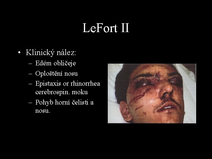 Le. Fort II • Klinický nález: – Edém obličeje – Oploštění nosu – Epistaxis