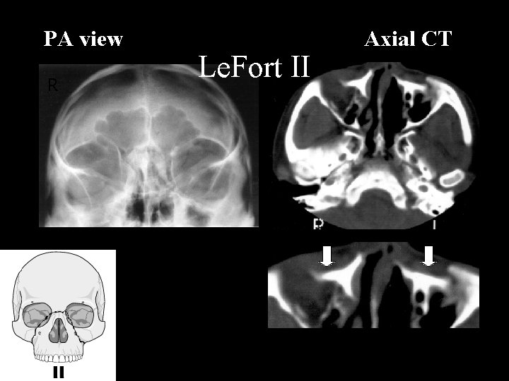PA view R Le. Fort II Axial CT 