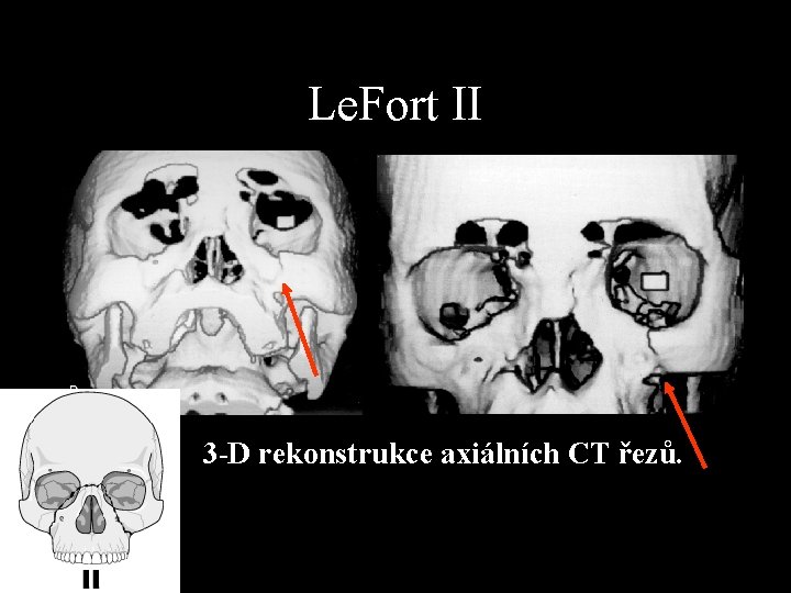 Le. Fort II 3 -D rekonstrukce axiálních CT řezů. 