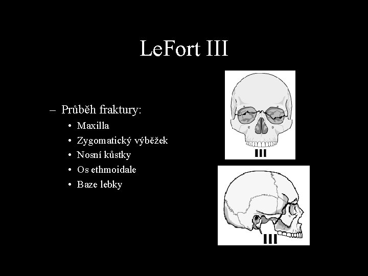 Le. Fort III – Průběh fraktury: • • • Maxilla Zygomatický výběžek Nosní kůstky
