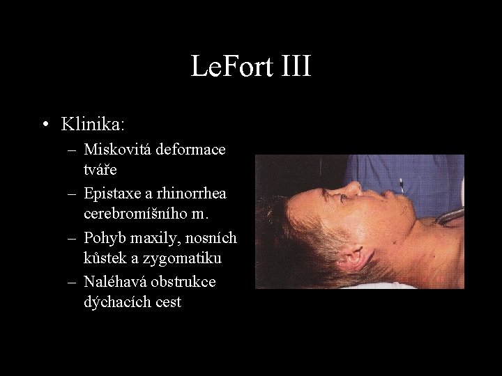 Le. Fort III • Klinika: – Miskovitá deformace tváře – Epistaxe a rhinorrhea cerebromíšního
