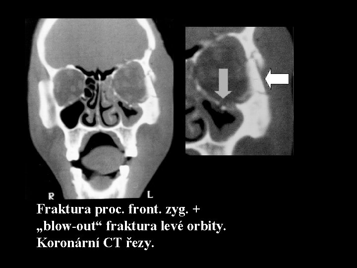 Fraktura proc. front. zyg. + „blow-out“ fraktura levé orbity. Koronární CT řezy. 
