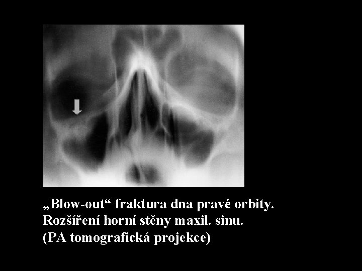 „Blow-out“ fraktura dna pravé orbity. Rozšíření horní stěny maxil. sinu. (PA tomografická projekce) 