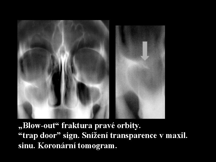 „Blow-out“ fraktura pravé orbity. “trap door” sign. Snížení transparence v maxil. sinu. Koronární tomogram.