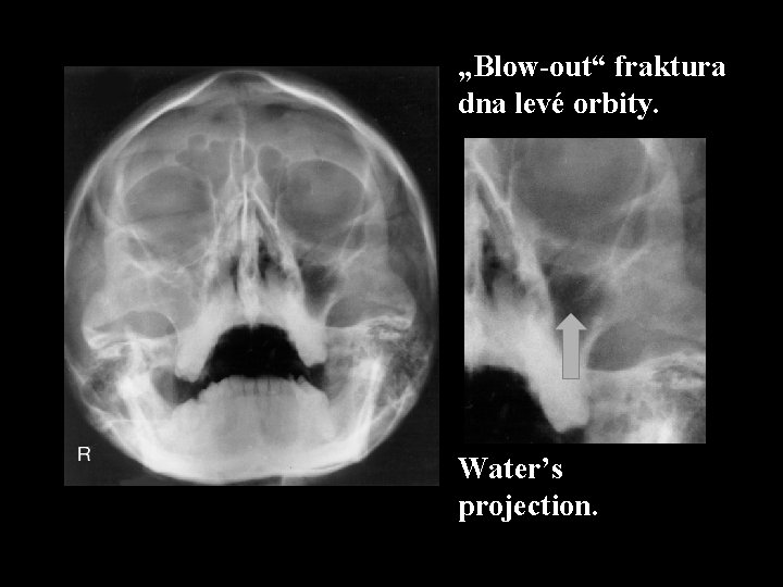 „Blow-out“ fraktura dna levé orbity. Water’s projection. 