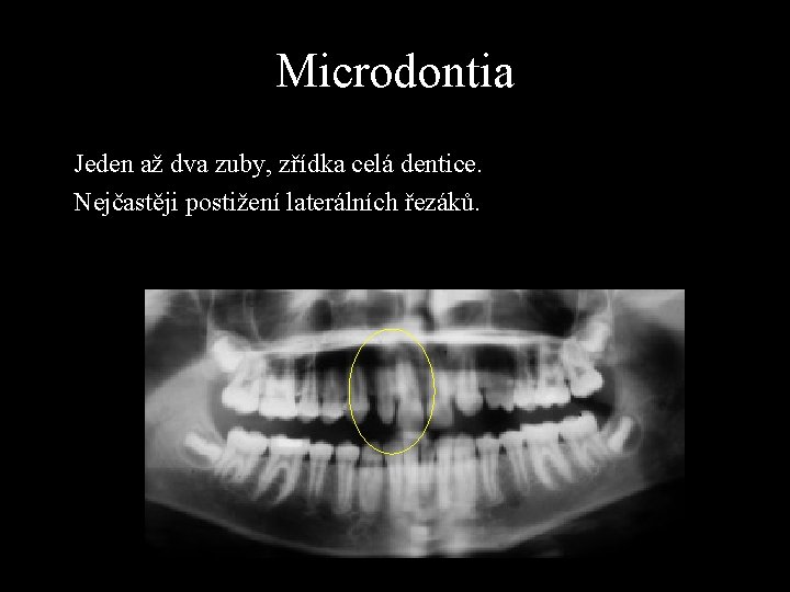 Microdontia Jeden až dva zuby, zřídka celá dentice. Nejčastěji postižení laterálních řezáků. 