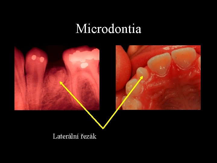 Microdontia Laterální řezák 