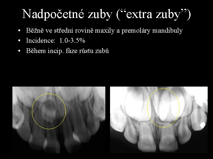 Nadpočetné zuby (“extra zuby”) • Běžně ve střední rovině maxily a premoláry mandibuly •