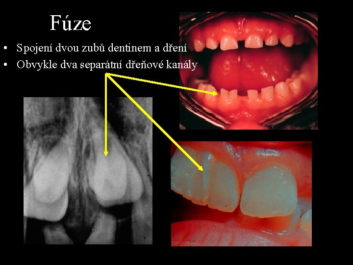 Fúze • Spojení dvou zubů dentinem a dření • Obvykle dva separátní dřeňové kanály