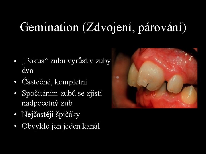 Gemination (Zdvojení, párování) • „Pokus“ zubu vyrůst v zuby • • dva Částečné, kompletní