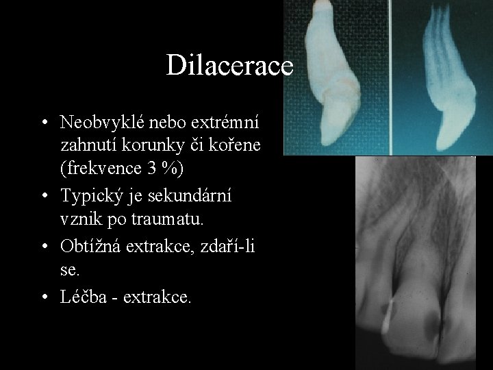 Dilacerace • Neobvyklé nebo extrémní zahnutí korunky či kořene (frekvence 3 %) • Typický