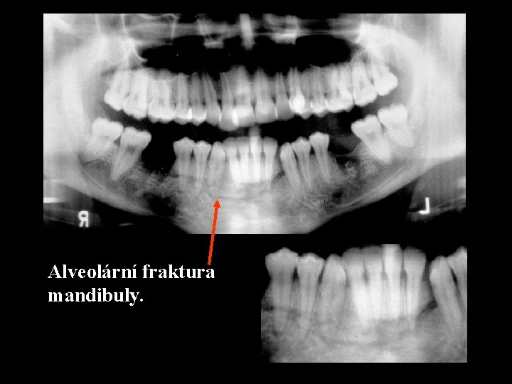 Alveolární fraktura mandibuly. 