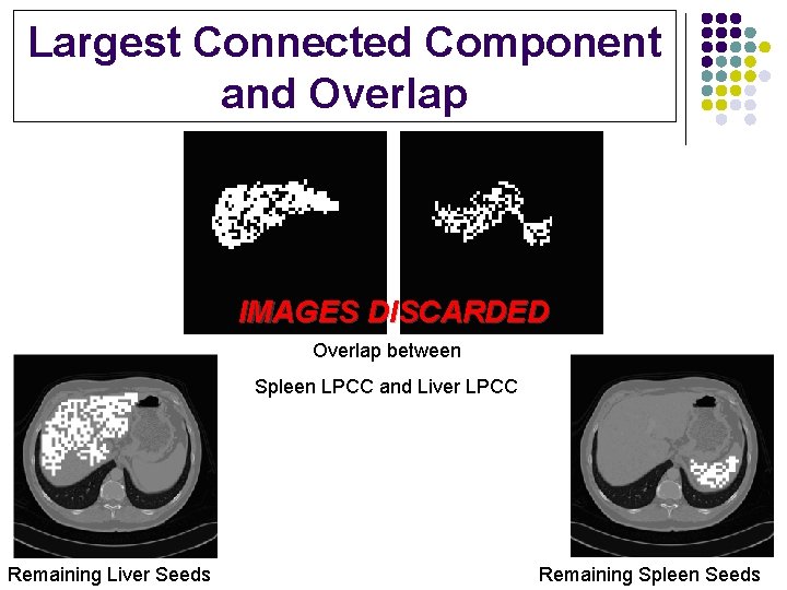 Largest Connected Component and Overlap IMAGES DISCARDED Overlap between Spleen LPCC and Liver LPCC
