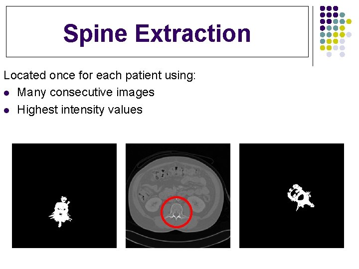 Spine Extraction Located once for each patient using: l Many consecutive images l Highest