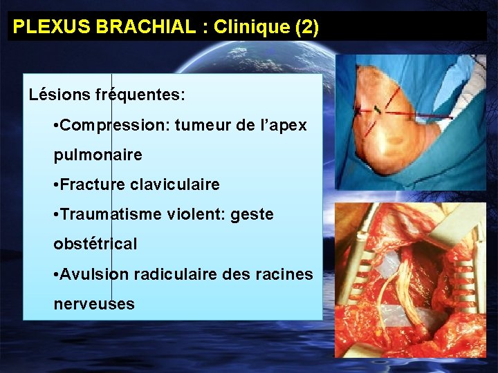PLEXUS BRACHIAL : Clinique (2) Lésions fréquentes: • Compression: tumeur de l’apex pulmonaire •