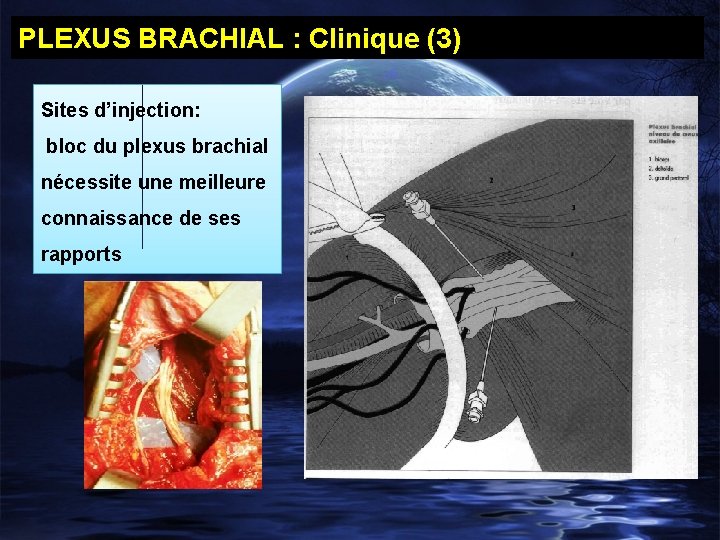 PLEXUS BRACHIAL : Clinique (3) Sites d’injection: bloc du plexus brachial nécessite une meilleure