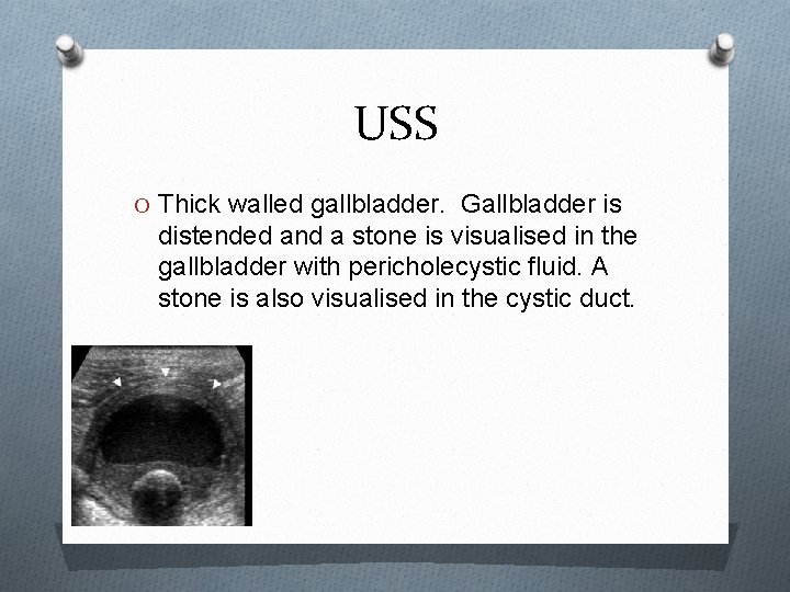 USS O Thick walled gallbladder. Gallbladder is distended and a stone is visualised in