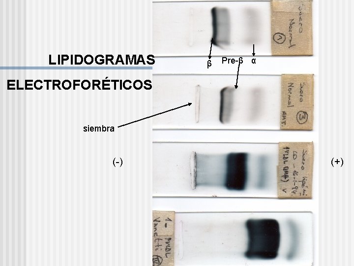 LIPIDOGRAMAS β Pre-β α ELECTROFORÉTICOS siembra (-) (+) 