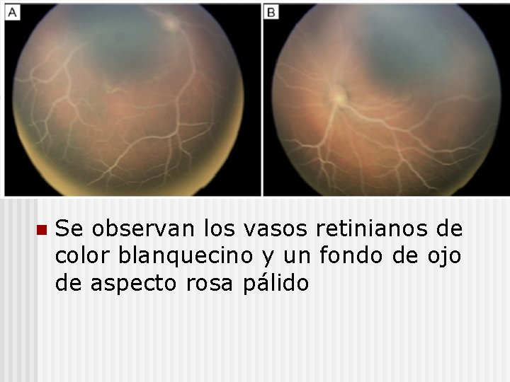 n Se observan los vasos retinianos de color blanquecino y un fondo de ojo