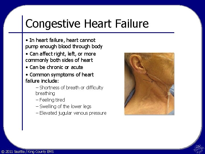 Congestive Heart Failure • In heart failure, heart cannot pump enough blood through body