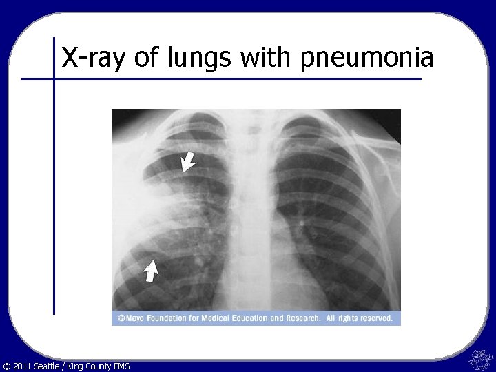 X-ray of lungs with pneumonia © 2011 Seattle / King County EMS 