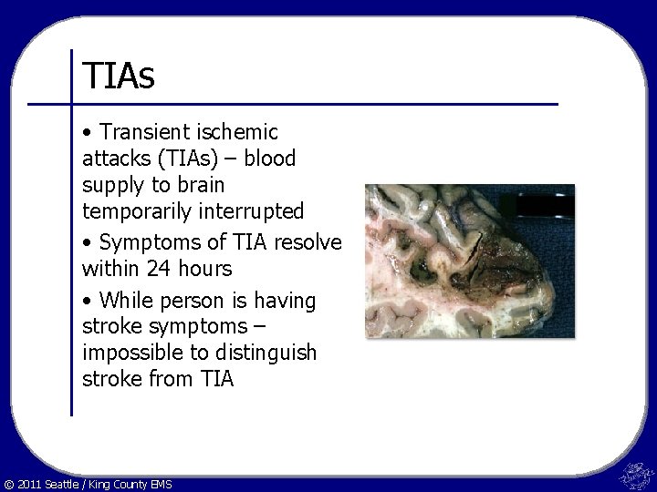 TIAs • Transient ischemic attacks (TIAs) – blood supply to brain temporarily interrupted •