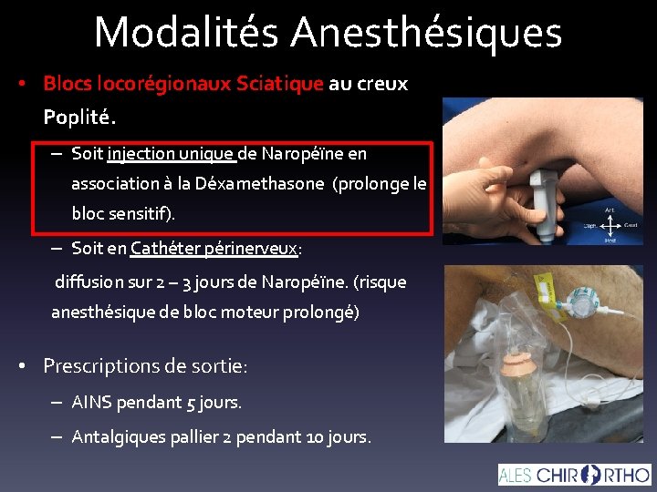 Modalités Anesthésiques • Blocs locorégionaux Sciatique au creux Poplité. – Soit injection unique de