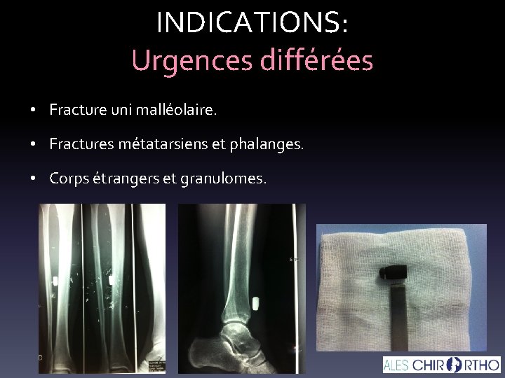 INDICATIONS: Urgences différées • Fracture uni malléolaire. • Fractures métatarsiens et phalanges. • Corps