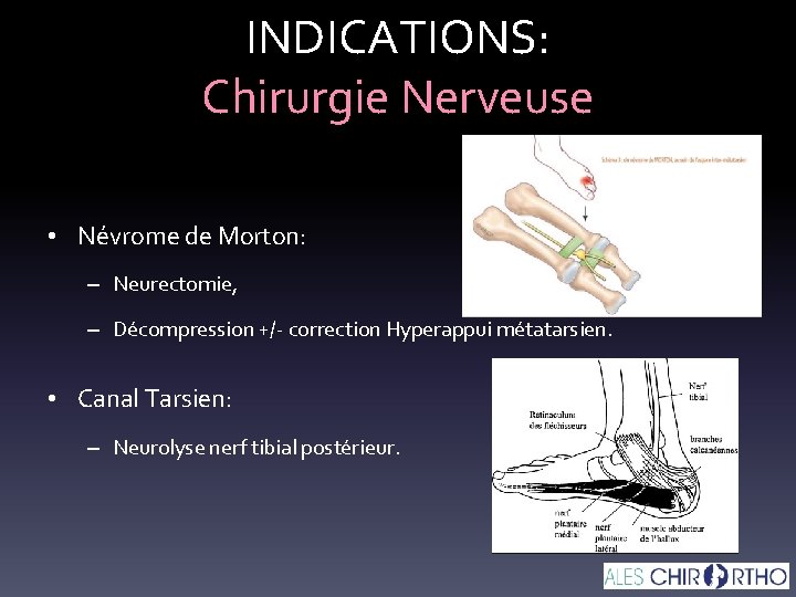 INDICATIONS: Chirurgie Nerveuse • Névrome de Morton: – Neurectomie, – Décompression +/- correction Hyperappui