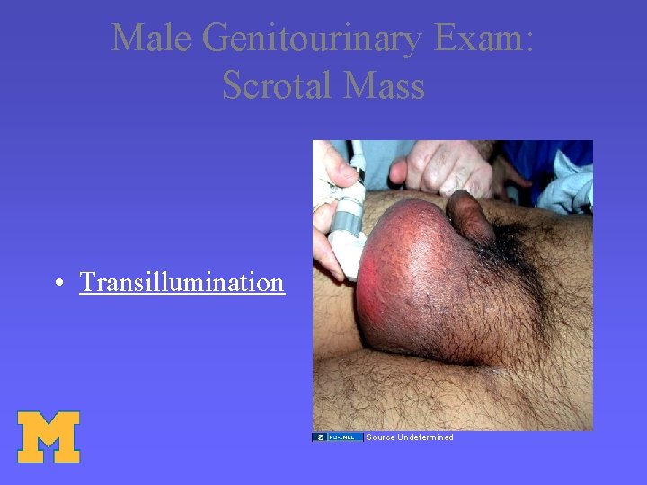 Male Genitourinary Exam: Scrotal Mass • Transillumination Source Undetermined 