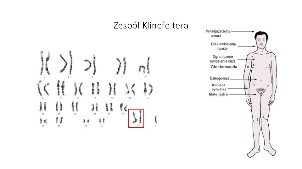 Zespół Klinefeltera 