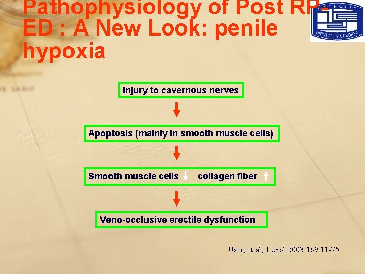 Pathophysiology of Post RPED : A New Look: penile hypoxia Injury to cavernous nerves