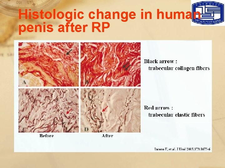 Histologic change in human penis after RP 