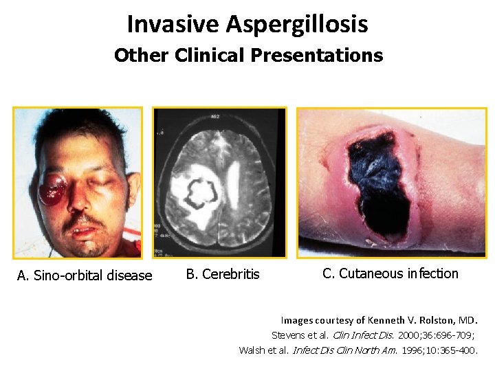 Invasive Aspergillosis Other Clinical Presentations A. Sino-orbital disease B. Cerebritis C. Cutaneous infection Images