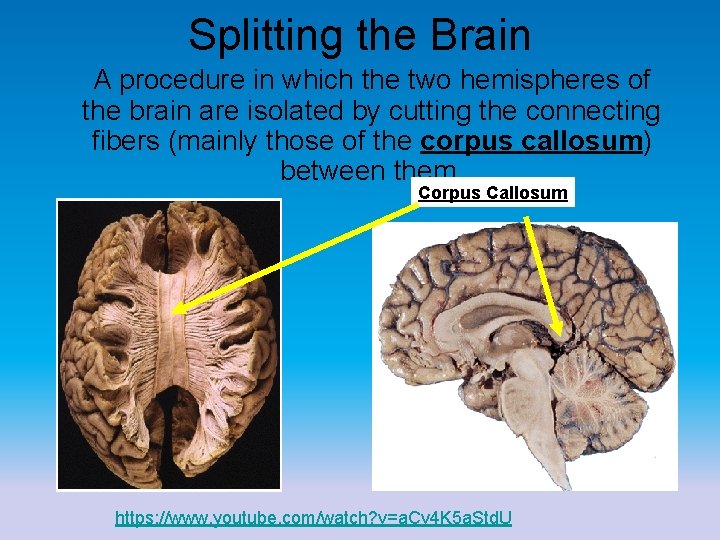 Splitting the Brain A procedure in which the two hemispheres of the brain are