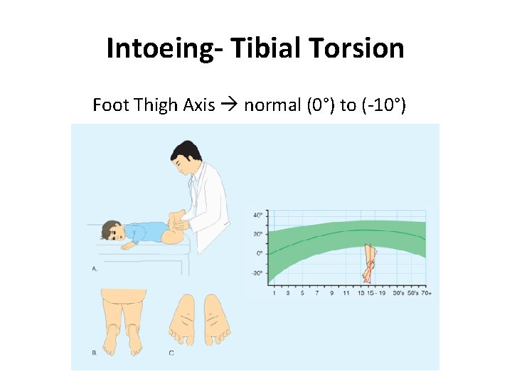 Intoeing- Tibial Torsion Foot Thigh Axis normal (0°) to (-10°) 