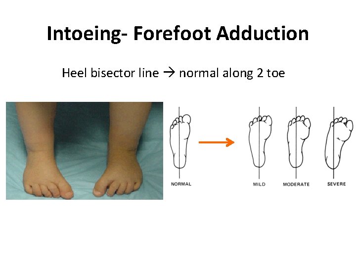 Intoeing- Forefoot Adduction Heel bisector line normal along 2 toe 
