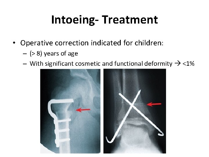 Intoeing- Treatment • Operative correction indicated for children: – (> 8) years of age