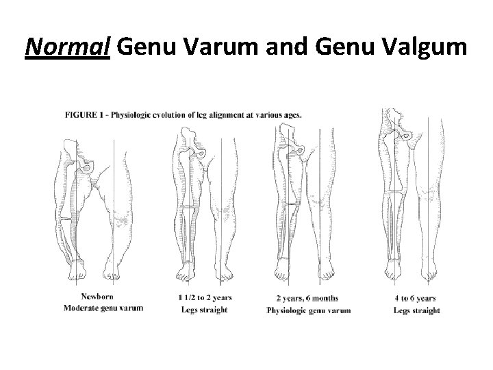 Normal Genu Varum and Genu Valgum 