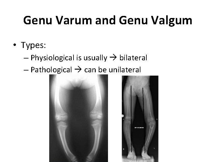 Genu Varum and Genu Valgum • Types: – Physiological is usually bilateral – Pathological